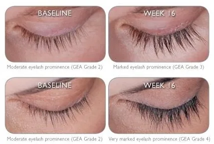 Eyelashes before and after LATISSE treatment